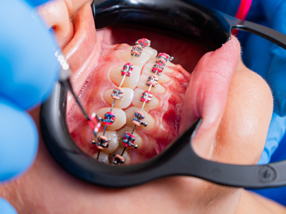 Braces in Nairobi